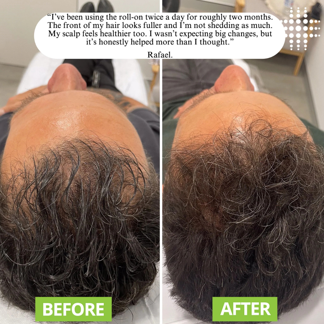 Regenx™ | Advanced Hair Growth Roll-on Serum